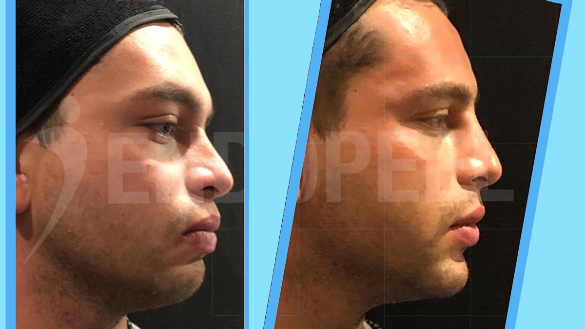 Endopeel advanced face and neck contouring before and after