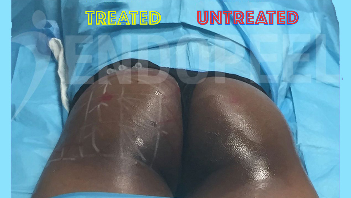 Endopeel buttocks contouring before and after