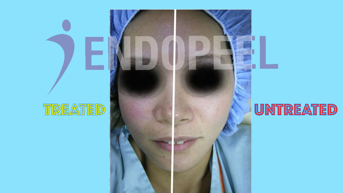 Endopeel nasal modulation and structural correction