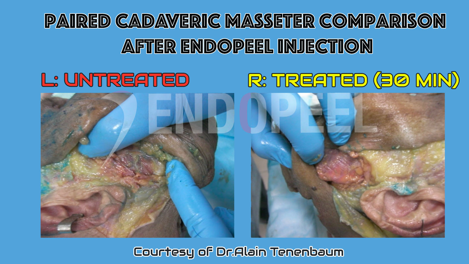 paired cadaveric masseter comparison after endopeel injection