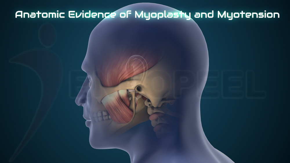 paired cadaveric masseter comparison untreated versus treated after Endopeel injection