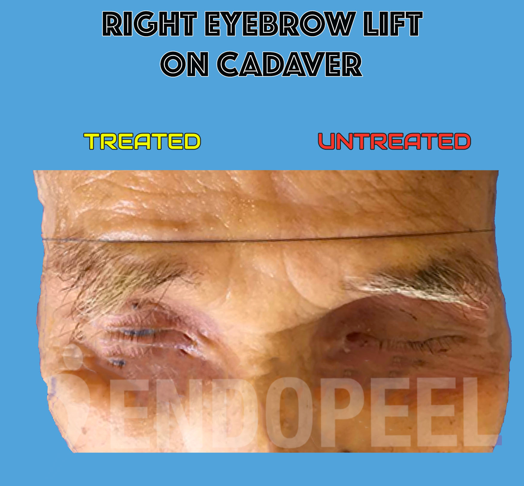 cadaver demonstration of eyebrow lift after Endopeel injection