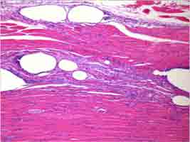 Histological section showing vacuolization phenomena after Endopeel injection