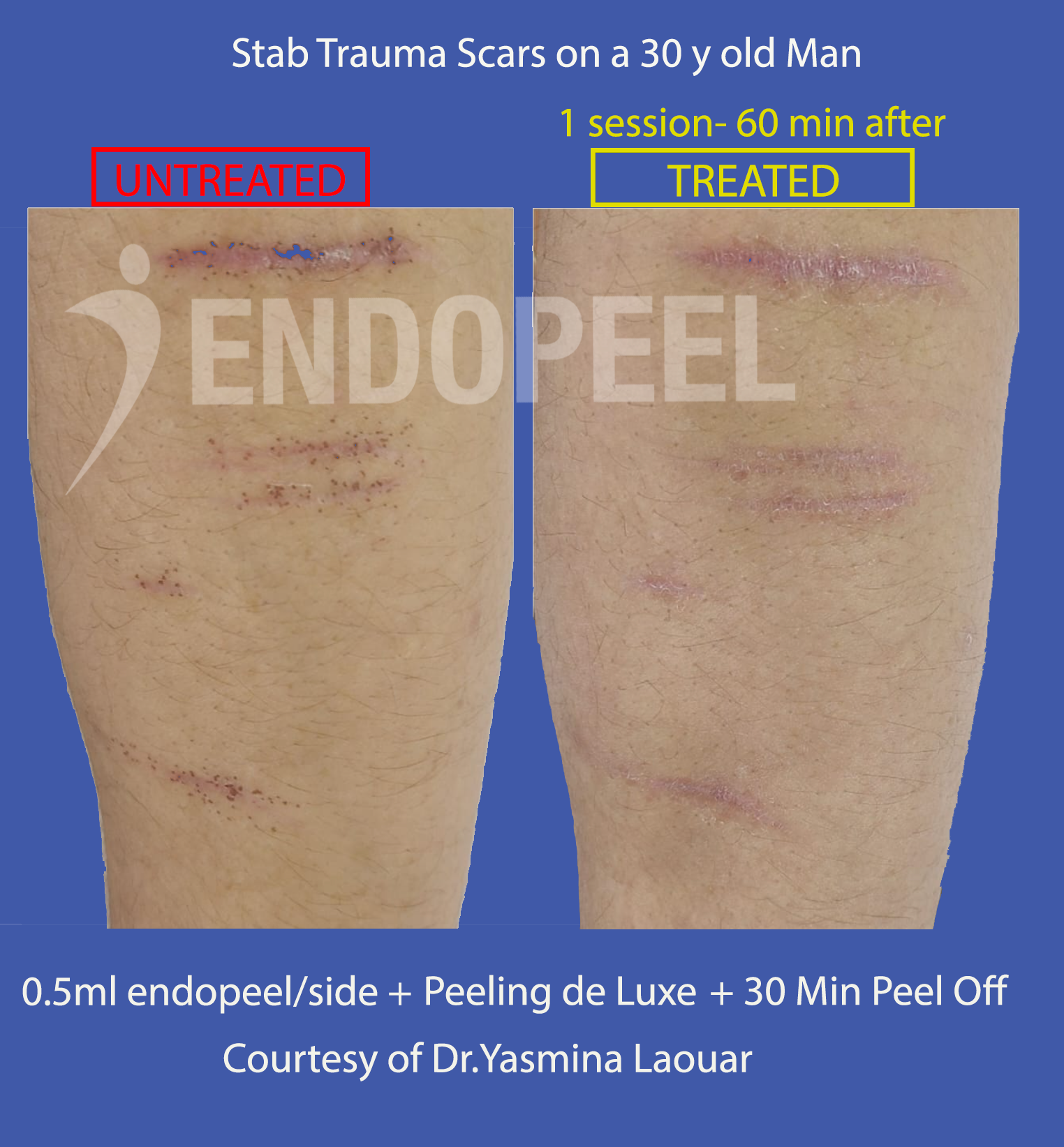 stab trauma scars