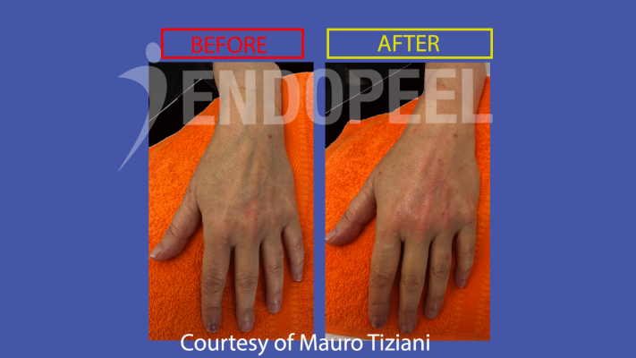 Handverjüngung